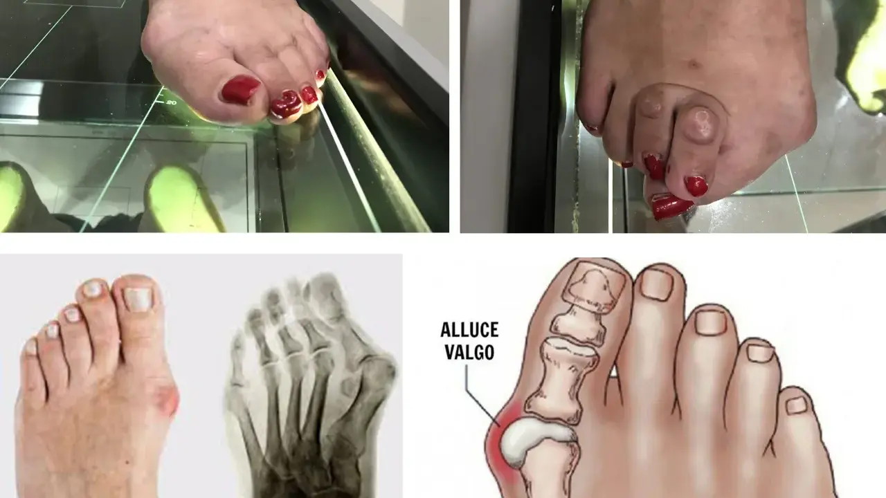 Immagini di piedi con alluce valgo, radiografie e un'illustrazione anatomica. Il dottore dei piedi, l'ortopedico, studia queste condizioni.