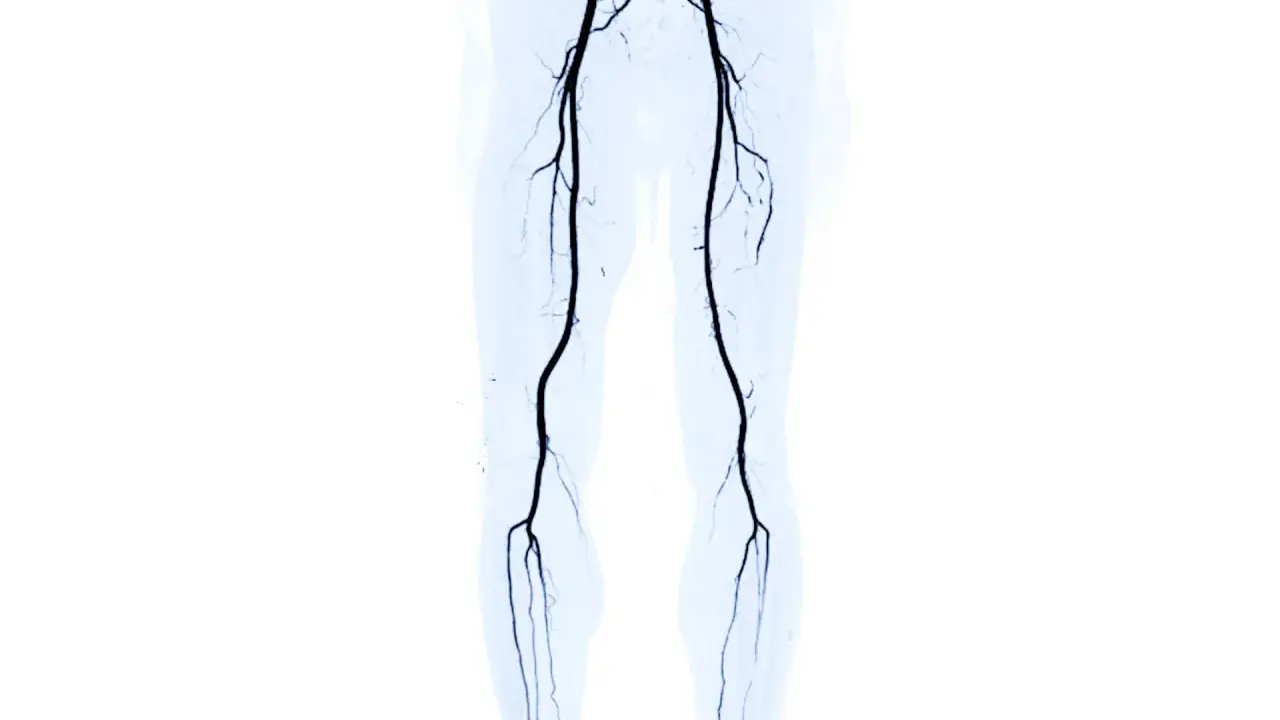 Angiografia delle gambe che mostra l'arteria femorale ostruita, un sintomo di problemi circolatori.