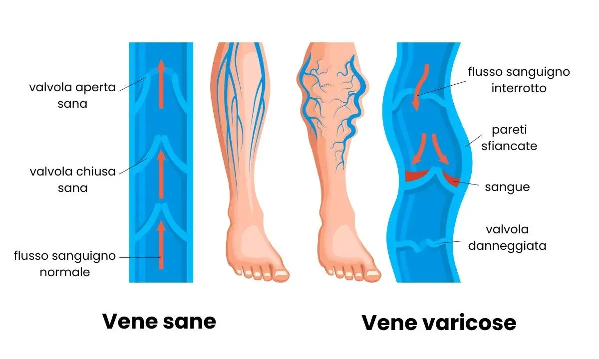 Illustrazione che mostra vene sane e vene varicose, evidenziando i problemi di insufficienza venosa gambe rimedi.