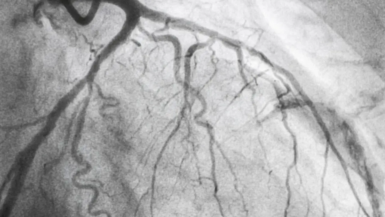 Immagine radiografica del cuore, mostrando le arterie coronarie dopo una coronarografia. Un passo importante nella convalescenza.