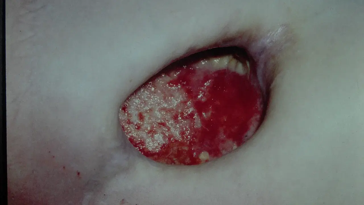 Piaga da decubito sacrale con tessuto necrotico e granulazione. Guida su come curare piaghe da decubito sacrali.