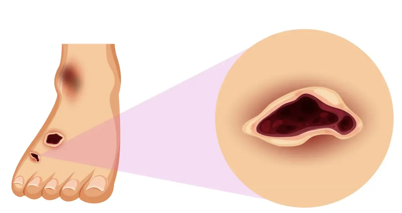 Ingrandimento di un piede con lesioni scure e profonde, che evidenzia la necessità di chi cura i piedi per trattare queste ferite.