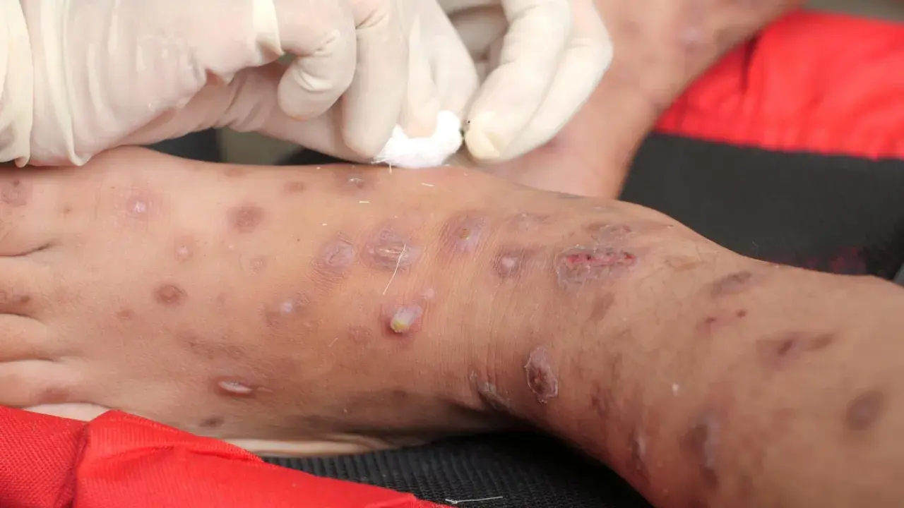 Gambe con lesioni cutanee, forse trattate con scabbia rimedi della nonna. Mani con guanti applicano un trattamento.