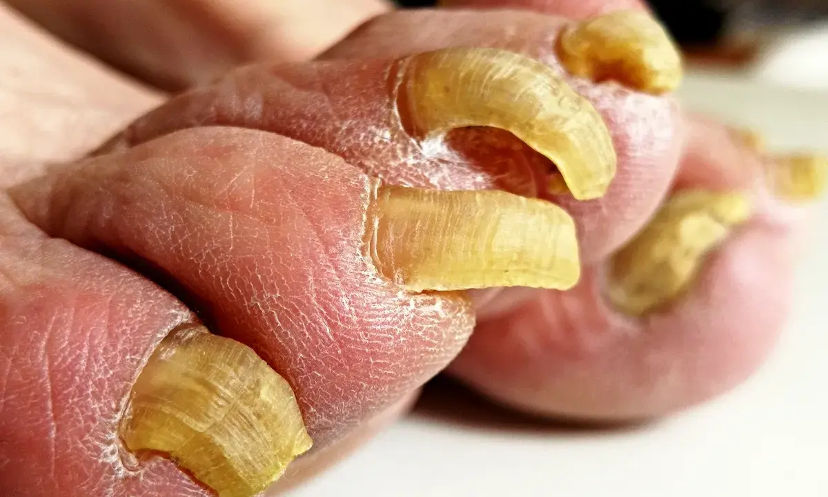 Primo piano di unghie doppie sui piedi, con pelle secca e screpolata.