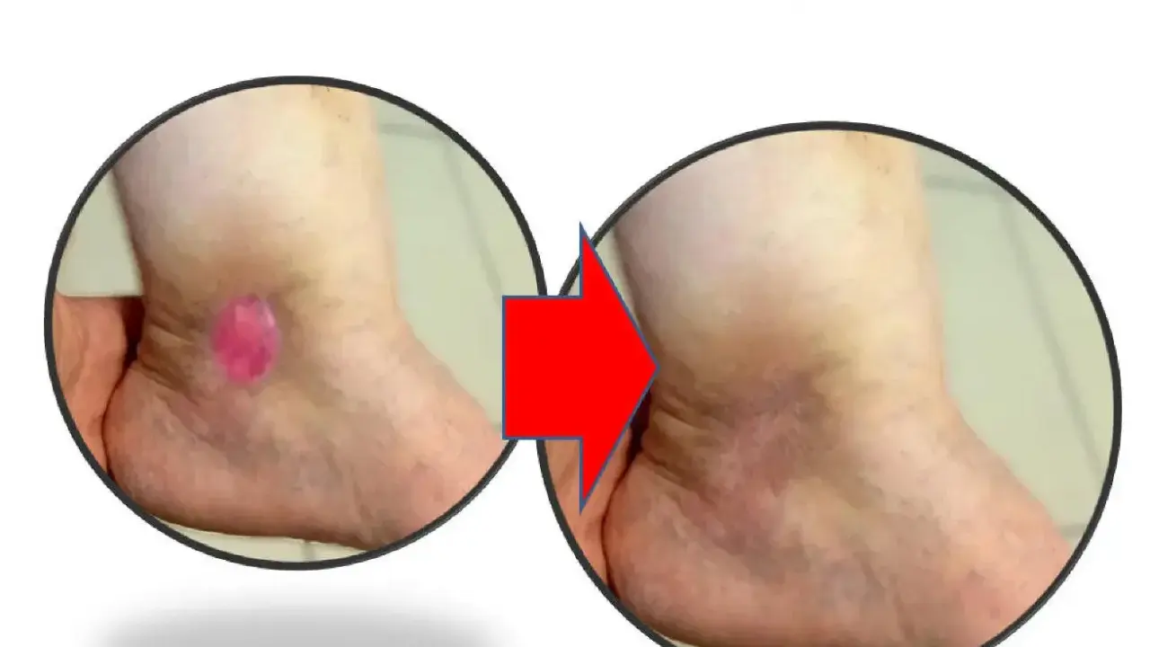 Prima e dopo: ulcere alle gambe che perdono acqua, ora in guarigione.