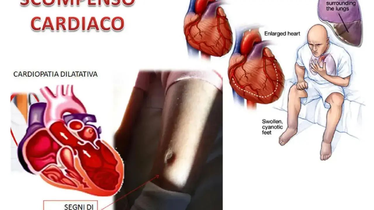 Illustrazione che mostra un cuore normale e ingrossato, un paziente con sintomi di scompenso cardiaco e fluidi polmonari. Lo scompenso cardiaco può regredire con cure adeguate.