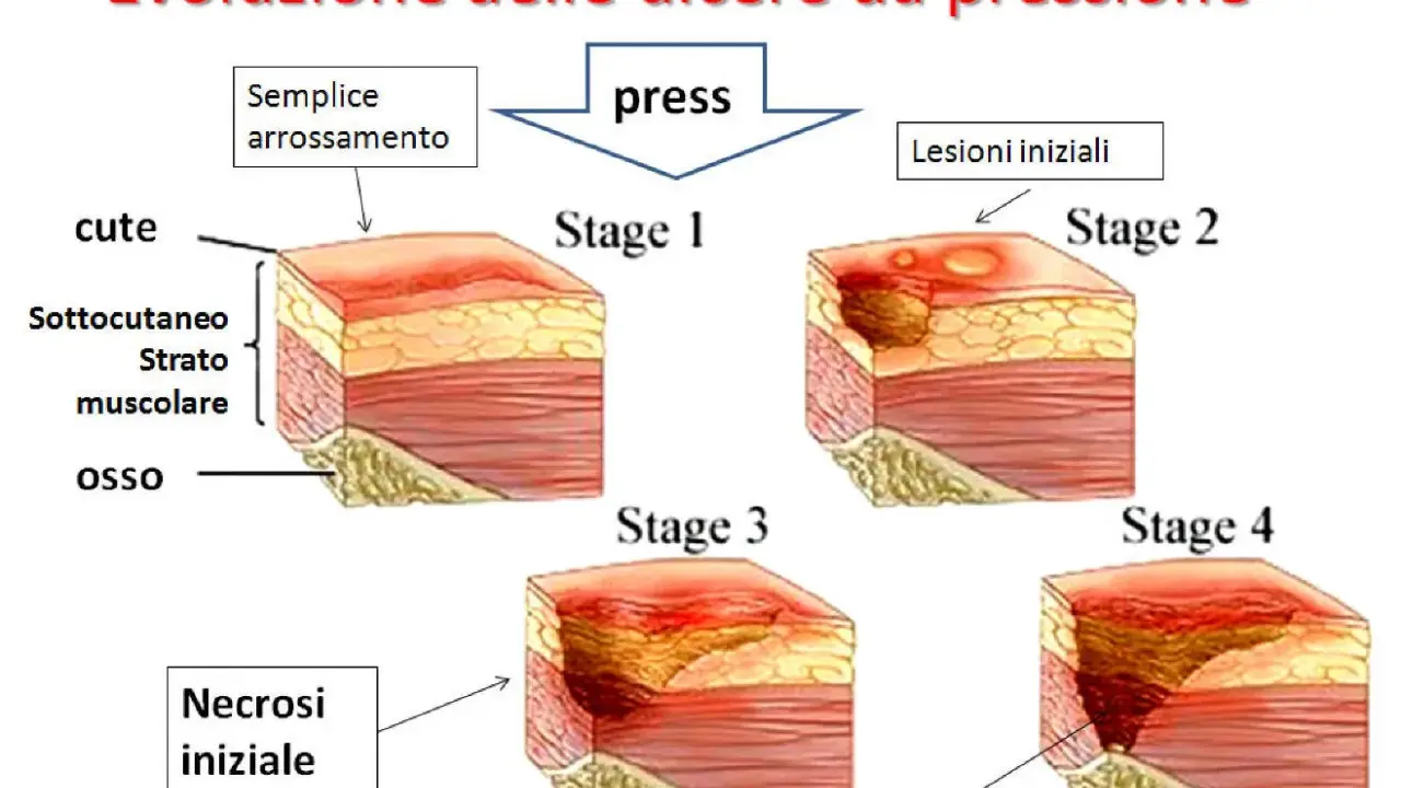 Evoluzione delle piaghe da decubito: da semplice arrossamento a necrosi profonda, mostrando le varie fasi di formazione.