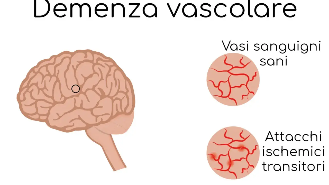 Illustrazione del cervello con un cerchio che indica un'area interessata da vasculopatia cerebrale cronica nell'anziano. Confronto tra vasi sanguigni sani e quelli colpiti da attacchi ischemici transitori.