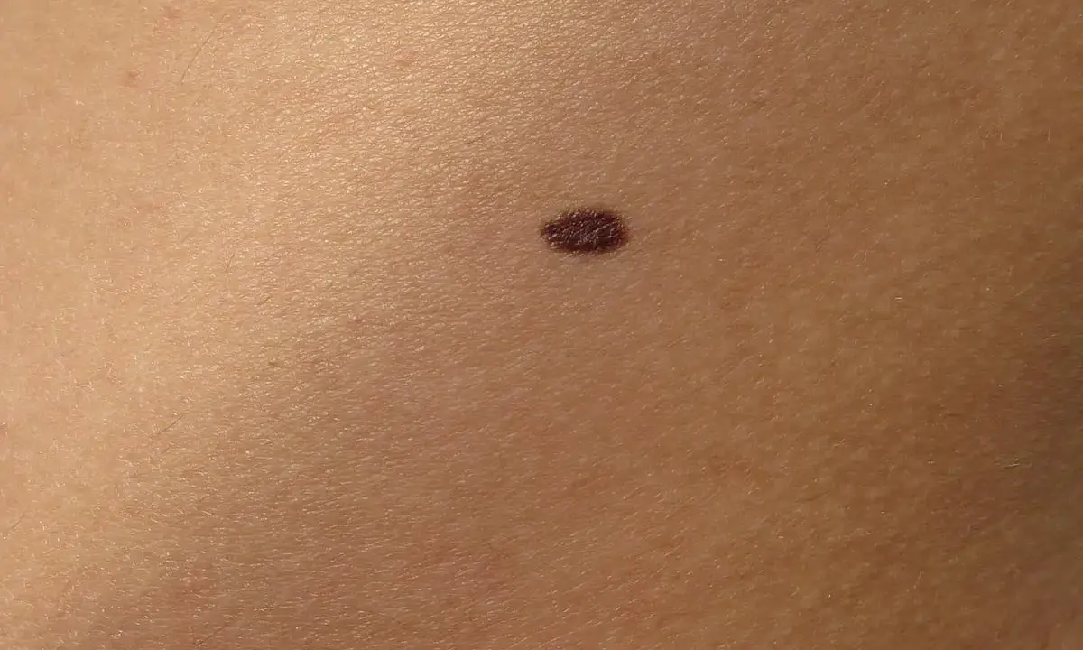 Un neo scuro sulla pelle, un piccolo punto che potrebbe nascondere insidie nei pericolosi.