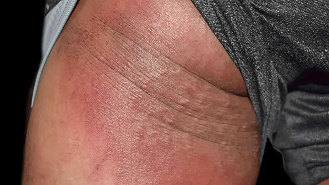 Arrossamento e piccole vescicole sulla pelle, indicative di dermatite sedere adulto.