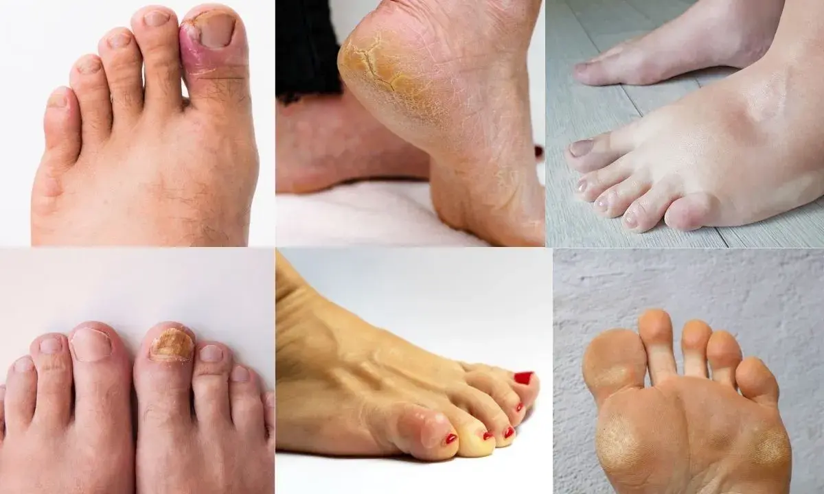 La podologia cos'è? Immagini di piedi con unghie incarnite, talloni screpolati, funghi, calli e gonfiore.