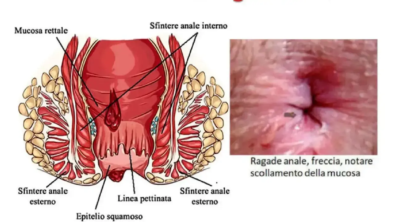 Illustrazione anatomica dell'ano e immagine di una ragade anale, che può causare dermatite perianale.