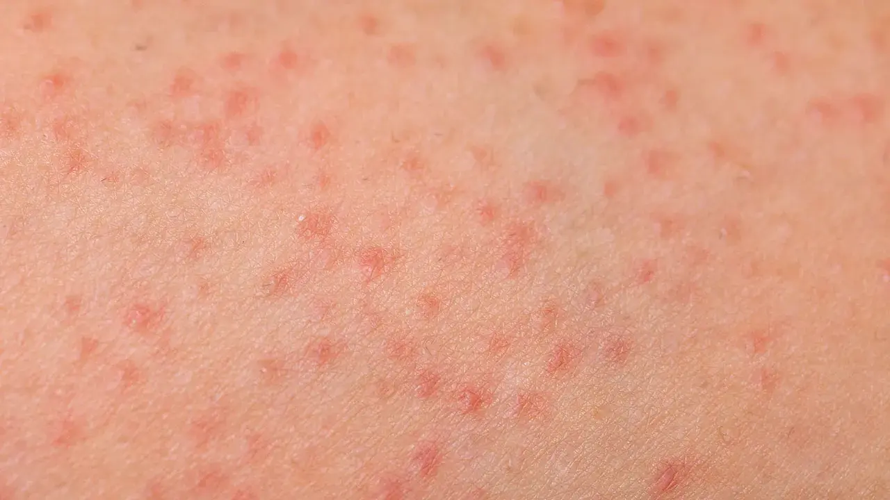 Pelle con prurito alle gambe, caratterizzata da numerosi puntini rossi che indicano un'irritazione cutanea.