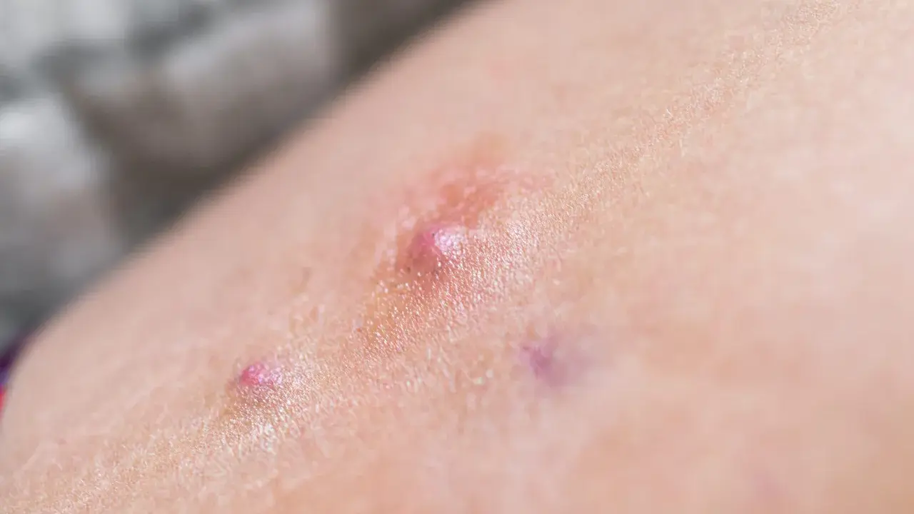 Pelle con arrossamento e piccole vescicole, indicative di dermatite bollosa.