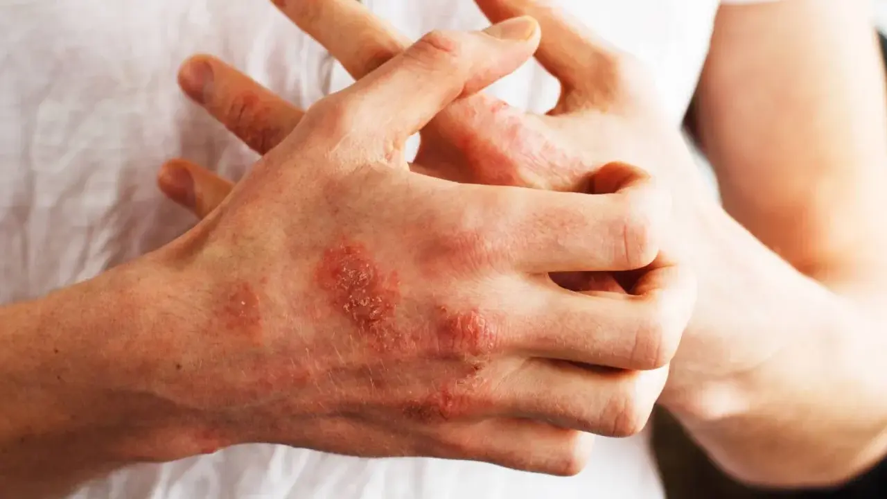 Mani con chiazze rosse e squamose, segno di psoriasi. Nonostante non sia mortale, la psoriasi può avere un impatto devastante sulla qualità della vita.