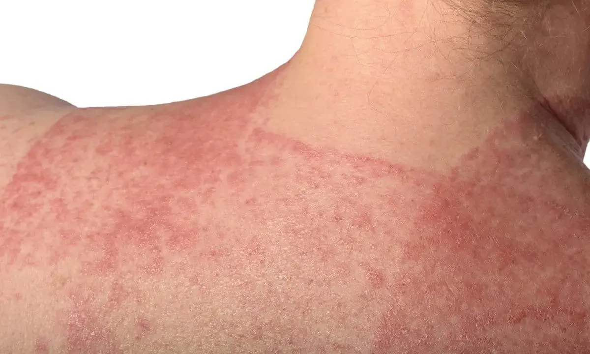 Pelle arrossata e irritata sulla spalla e sul collo, con chiazze evidenti. Potrebbe essere un caso di dermatite da incontinenza.