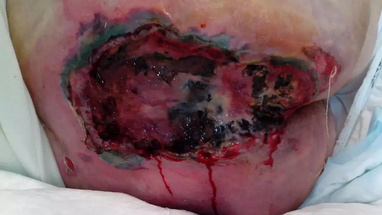 Grave lesione da decubito con tessuto necrotico e sanguinamento. La prevenzione piaghe da decubito è fondamentale per evitare queste condizioni.