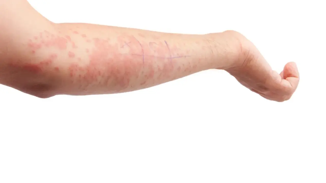 Braccio con eruzione cutanea rossa e pruriginosa, possibile reazione allergica o cause del prurito. Segni a matita sulla pelle.
