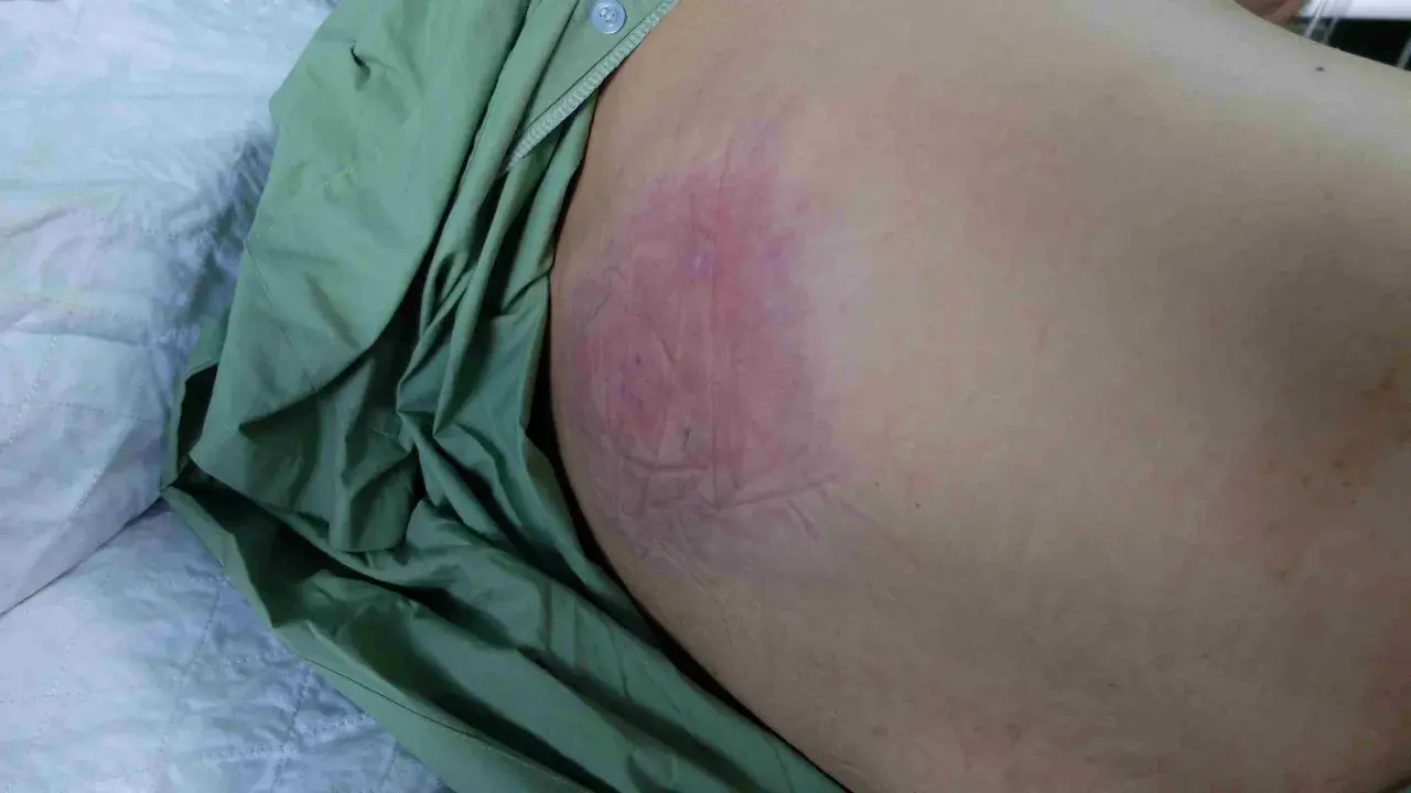 Arrossamento e lesione cutanea, possibile piaga da decubito nera come curarla. Necessario intervento medico.