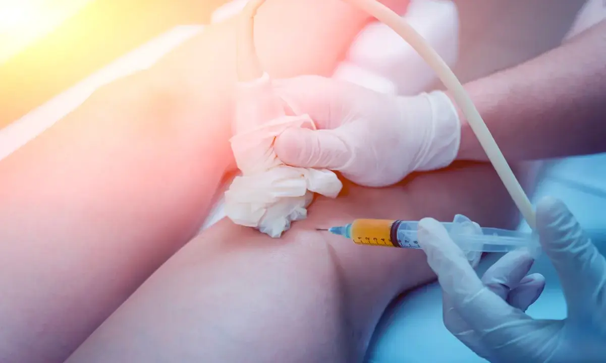 Mano con guanto in lattice esegue iniezione di plasma nel ginocchio, guidata da ecografo. Nonostante il fastidio, fa male togliere il liquido dal ginocchio.