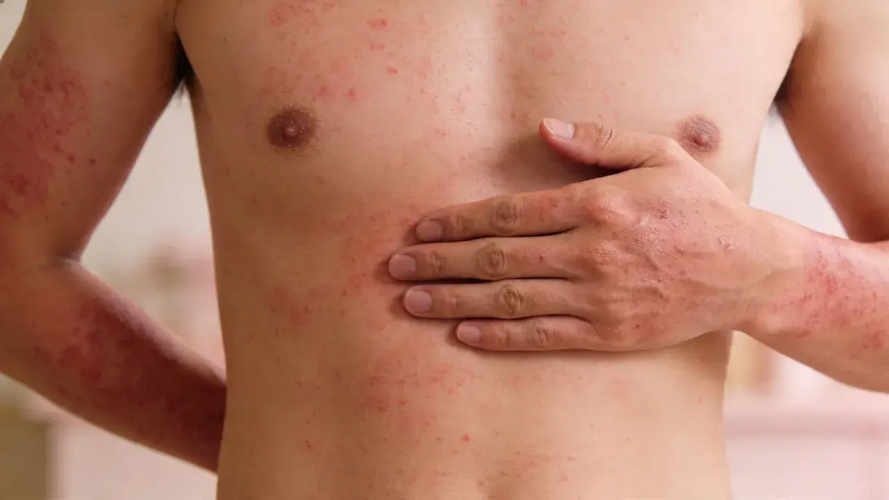 Torso e braccia di una persona con estese irritazioni cutanee rosse e pruriginose.