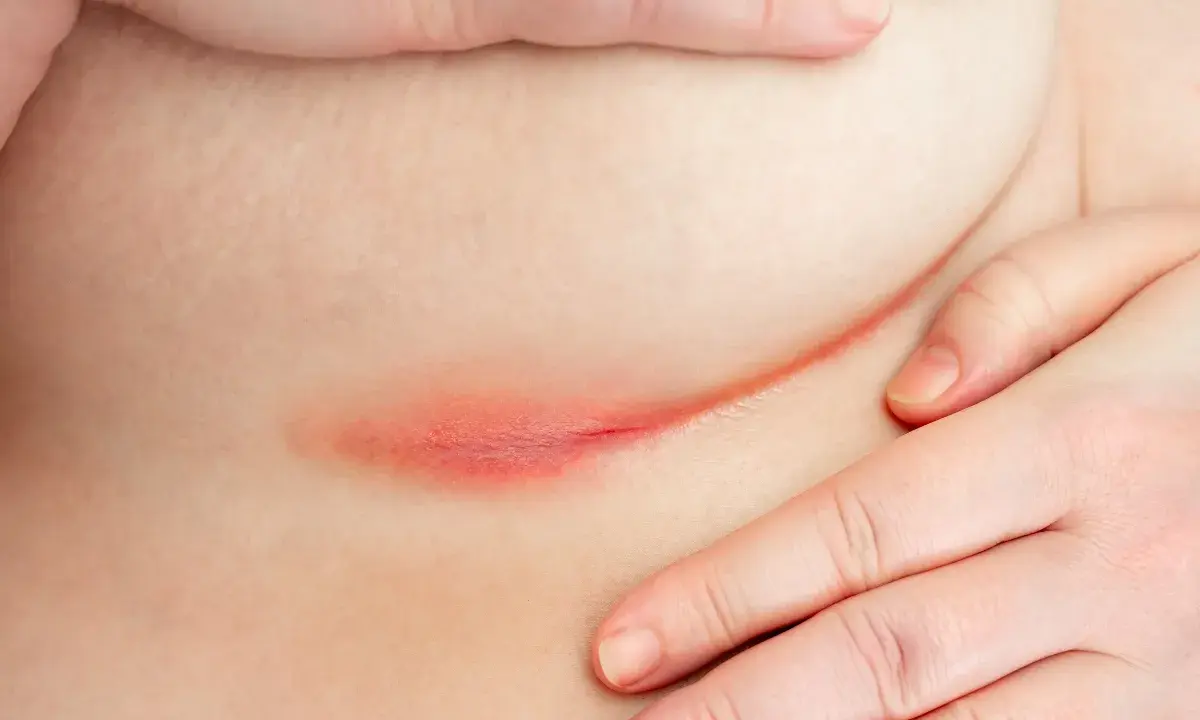 Pelle assottigliata da cortisone, arrossata e irritata. Si cercano rimedi per lenire l'infiammazione e ripristinare la barriera cutanea.