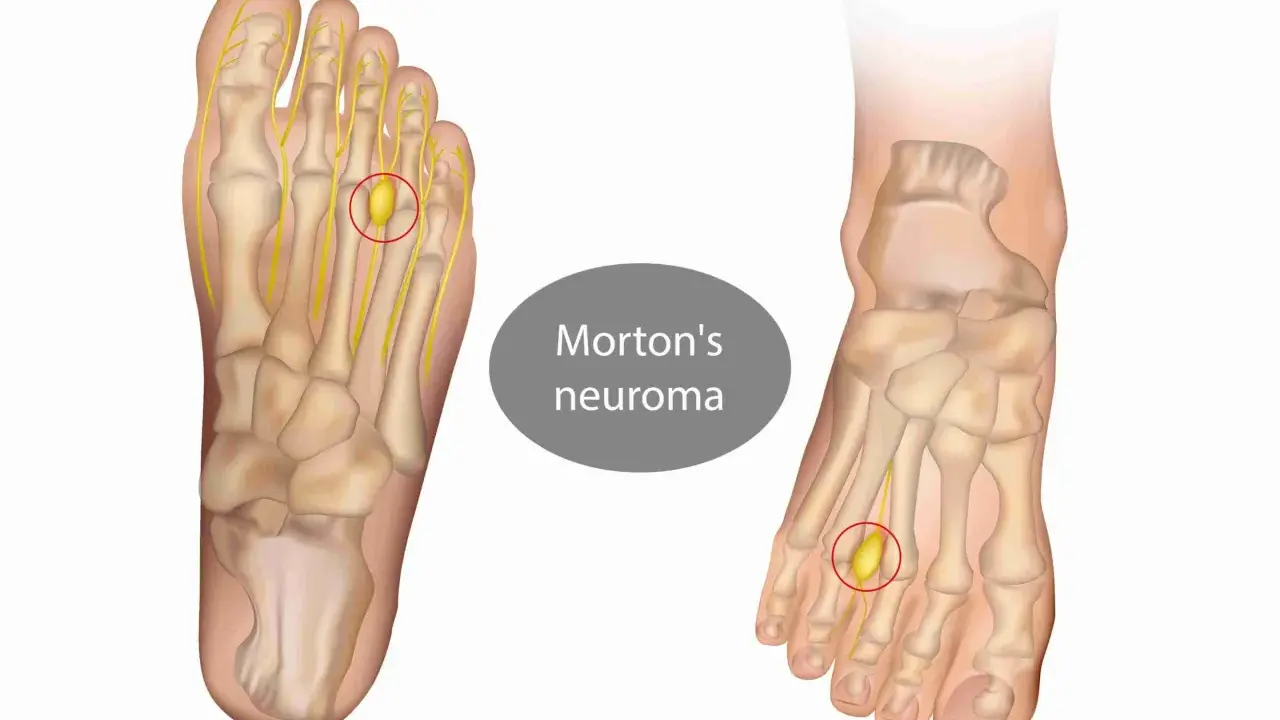 Illustrazione anatomica del piede che mostra un neuroma di Morton, una condizione che rende difficile camminare.