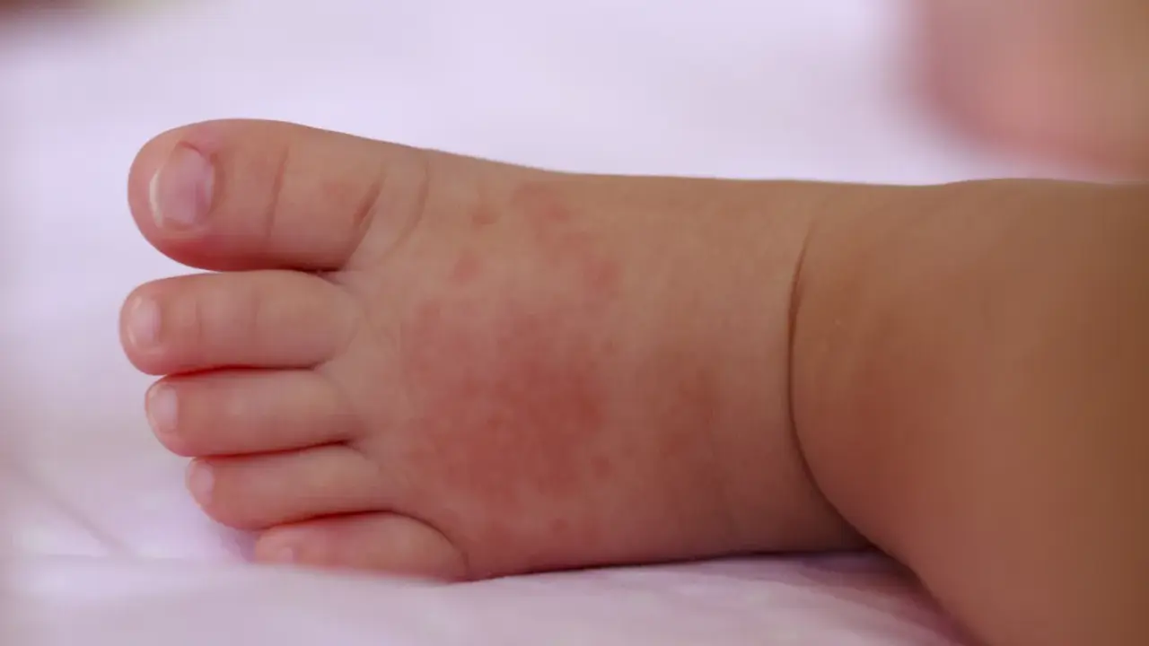 Piedino di neonato con piccoli puntini da sudore rossastri sulla pelle.
