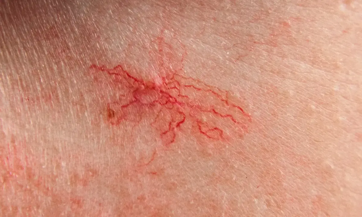 Primo piano di capillari rotti sulla pelle, un segno che i capillari rotti si possono riassorbire.