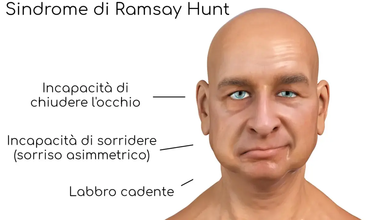 Volto con paralisi facciale da Sindrome di Ramsay Hunt: occhio non chiudibile, sorriso asimmetrico e labbro cadente.