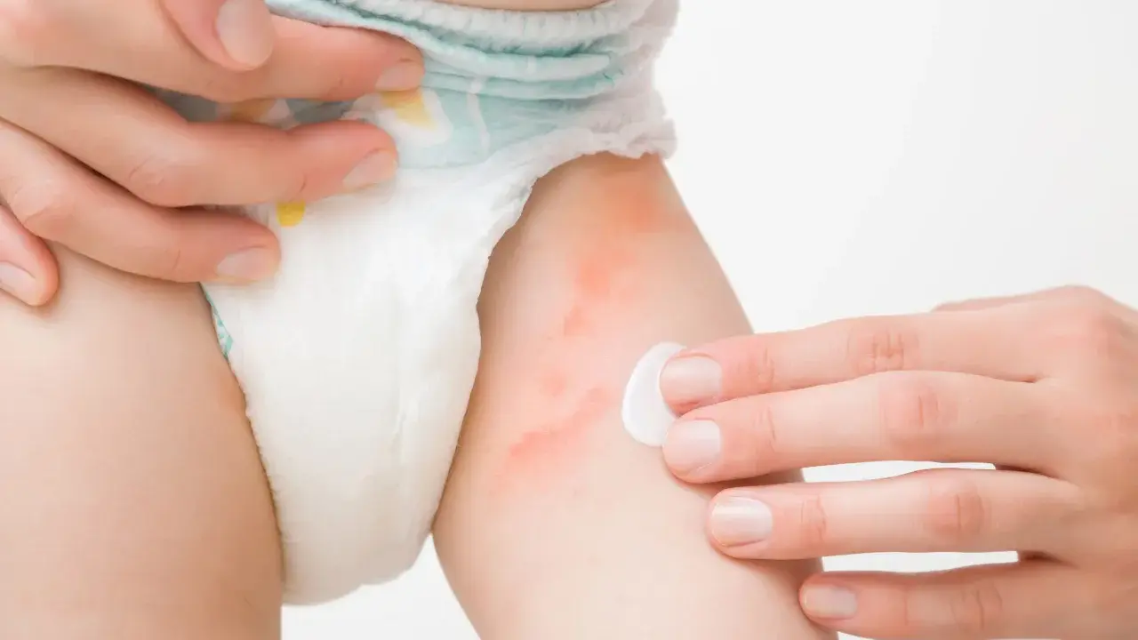 Mano applica crema su pelle arrossata di neonato, sintomo di ustione da pannolino.