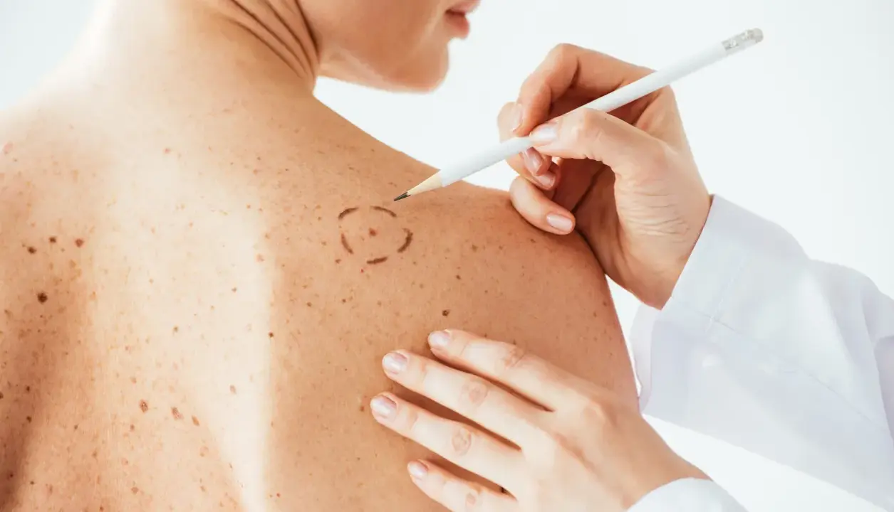 Medico disegna cerchio su neo per asportazione. La convalescenza dopo asportazione neo è un momento delicato.