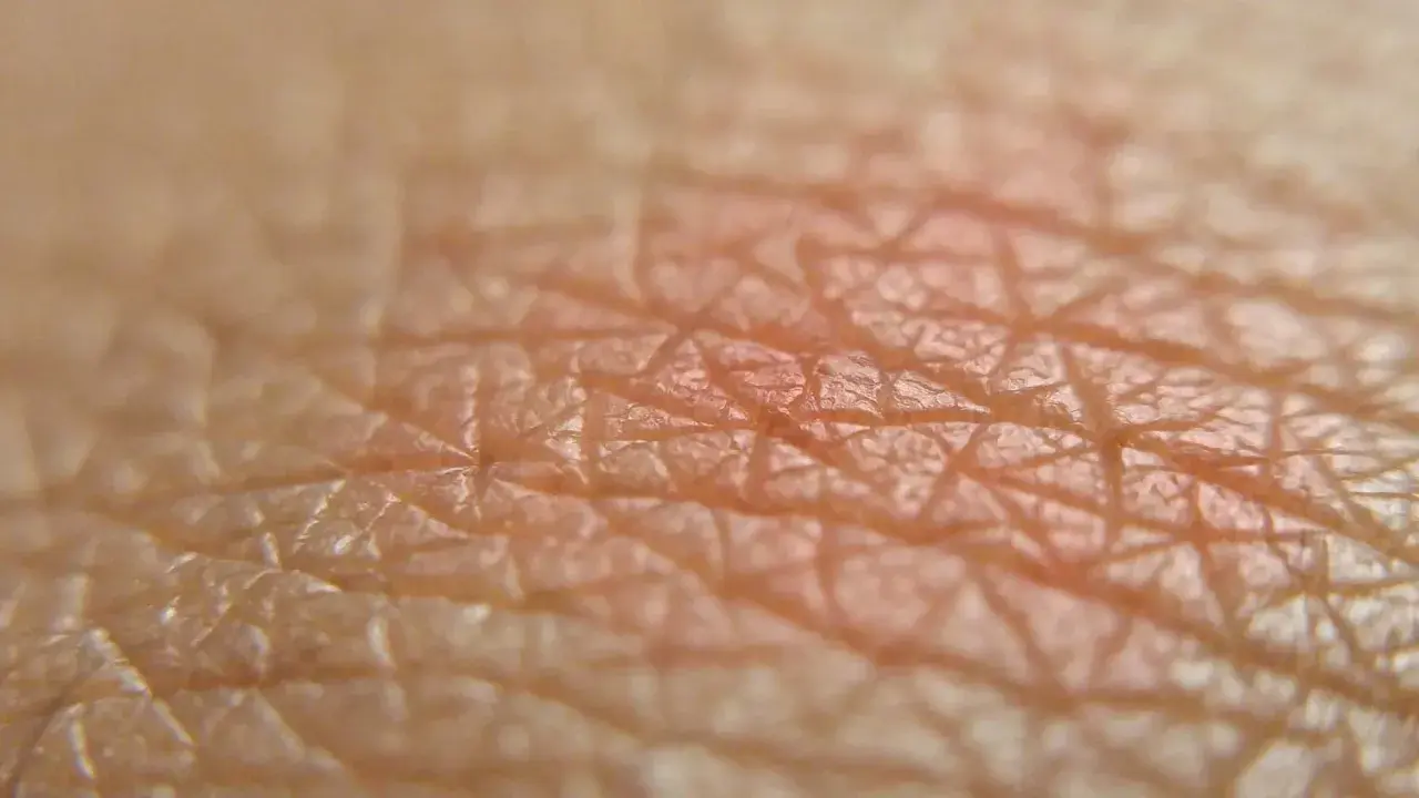 Close-up della pelle con arrossamento, suggerisce irritazione piega sedere rimedi.