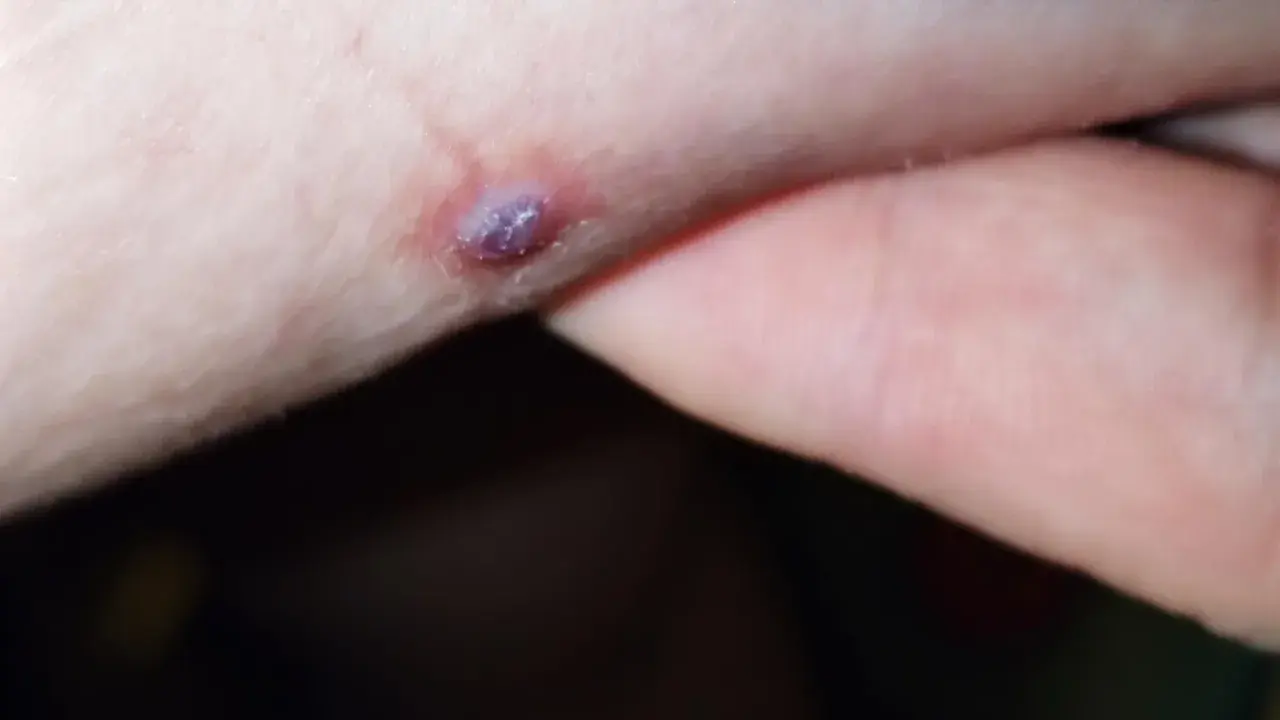 Una piccola piaga da decubito che sanguina, con un'area violacea al centro, su pelle chiara.