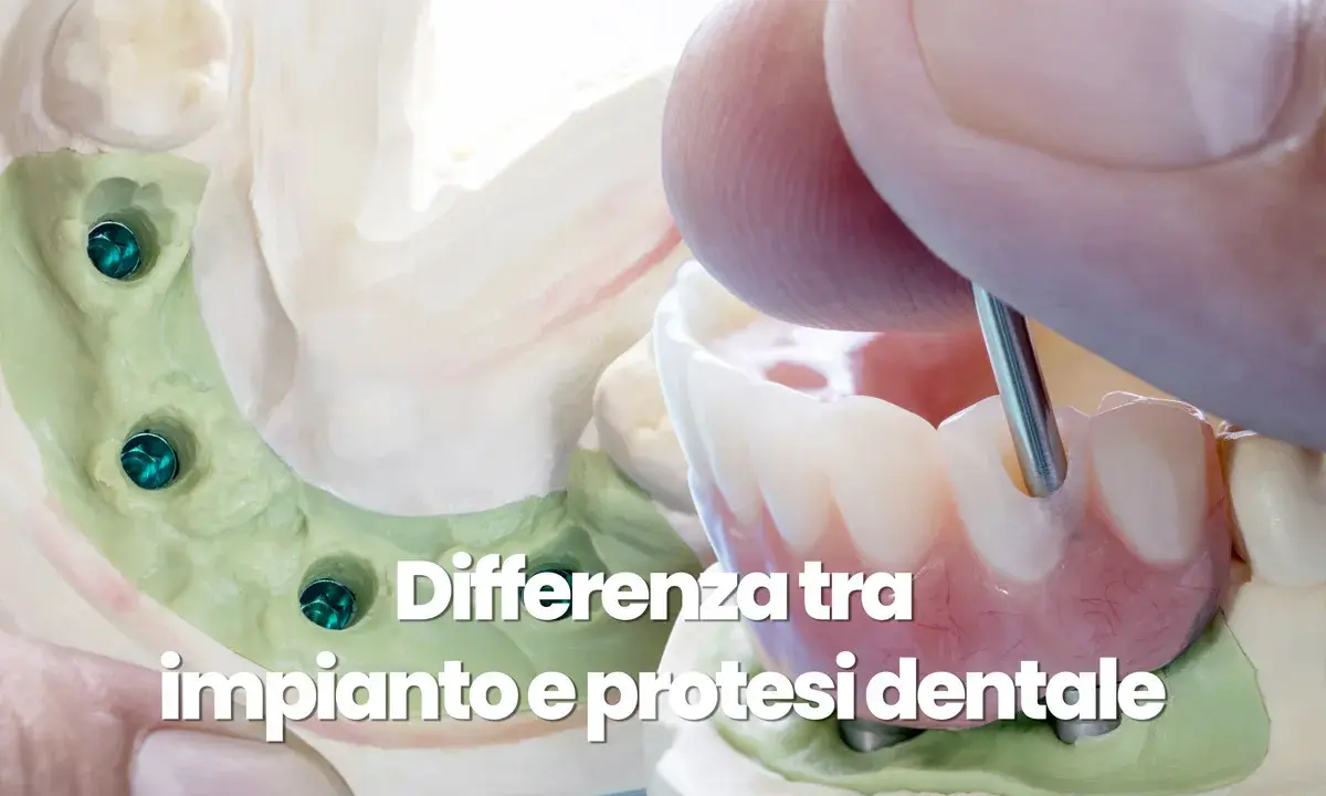 Modello dentale con impianti e protesi. L'igiene del cavo orale è fondamentale per la salute dei denti.