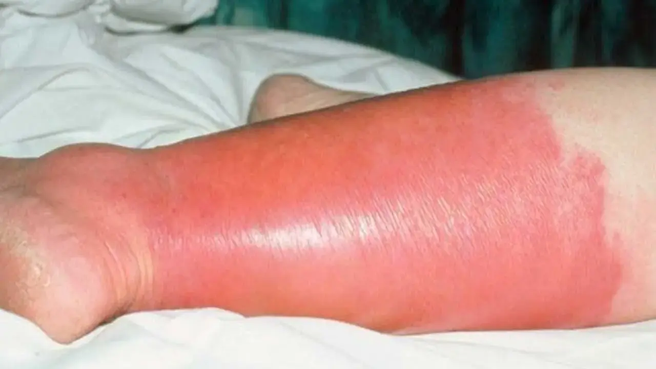Gamba gonfia e arrossata, con segni di erisipela. La pelle appare lucida e tesa, con un'area di infiammazione estesa.