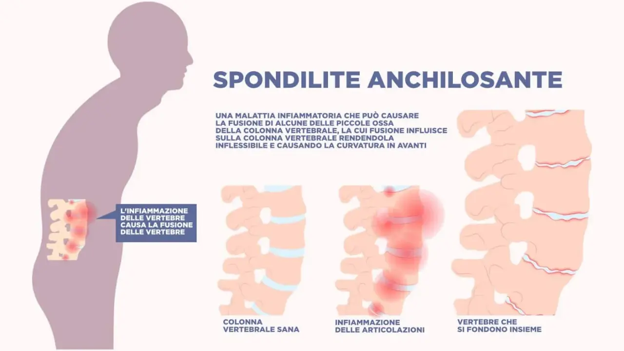 Spondilite anchilosante: infiammazione vertebrale che causa fusione ossea, rendendo la colonna rigida e curva in avanti.