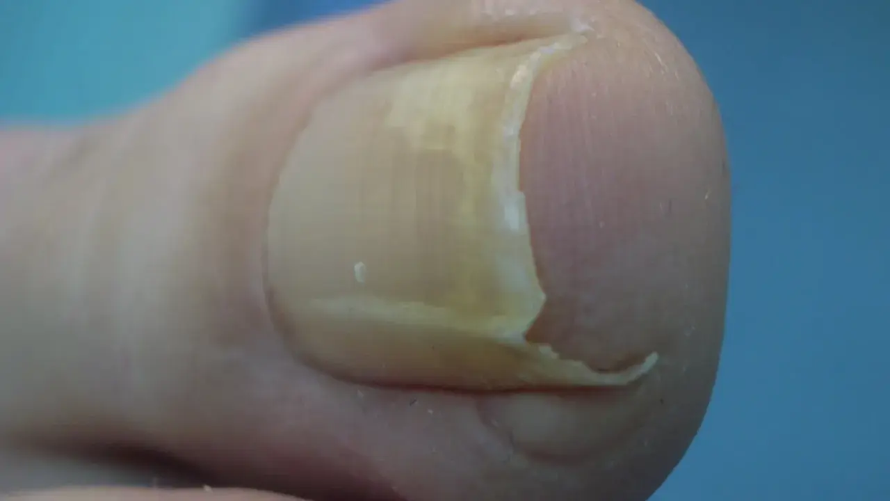Dettaglio di un'unghia del piede con ispessimento e curvatura, che ricorda un'unghia a uncino.