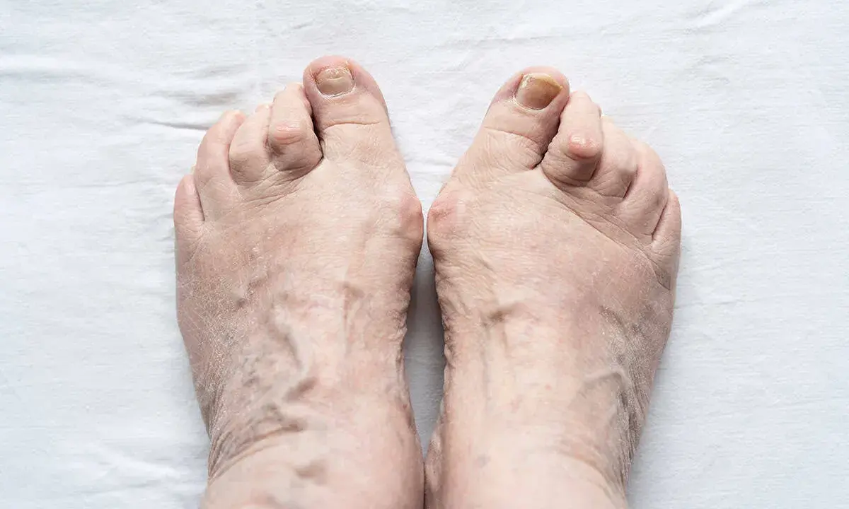 Piedi anziani con evidenti vene varicose e dita leggermente deformate, segno di piedi gonfi anziani.