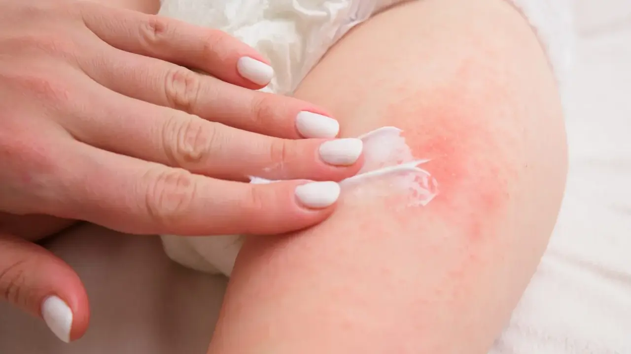 Mano applica crema su pelle arrossata, trattando una piaga da pannolino.