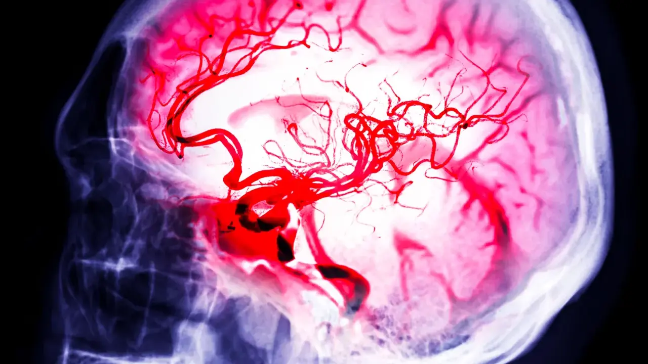 Immagine radiografica di un cervello con vasi sanguigni rossi evidenziati, che simboleggiano la lotta per l'aneurisma cerebrale sopravvivenza.