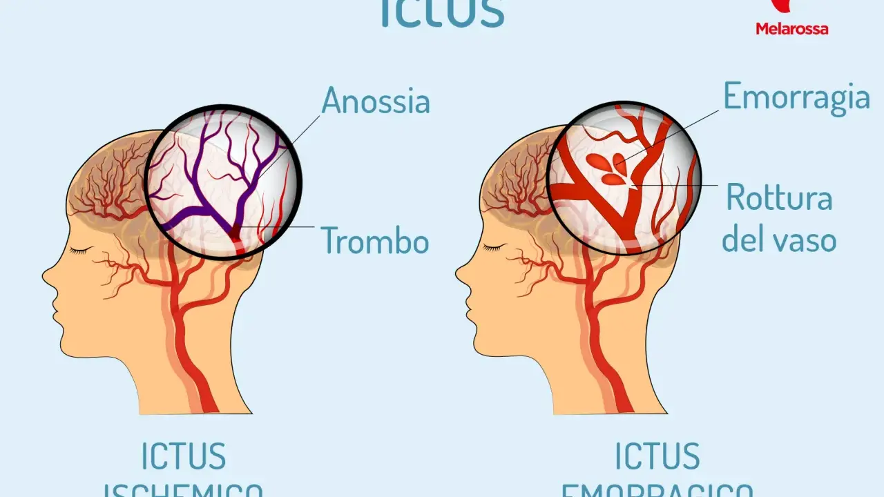Ictus: confronto tra ischemico (trombo) ed emorragico (rottura vaso). L'emorragia cerebrale negli anziani è un rischio.