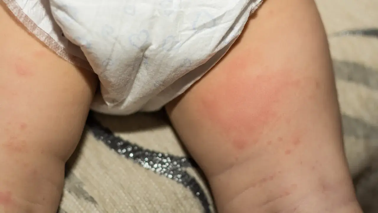 Pelle arrossata e irritata con piccole bollicine nella zona pannolino di un neonato.