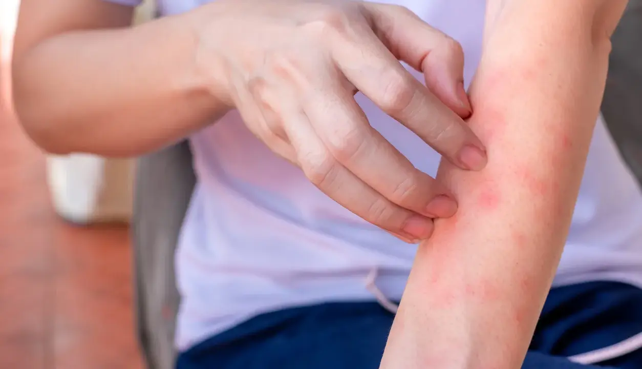 Braccio con pelle arrossata e puntini rossi, che indica la necessità di rimedi per l'irritazione cutanea.