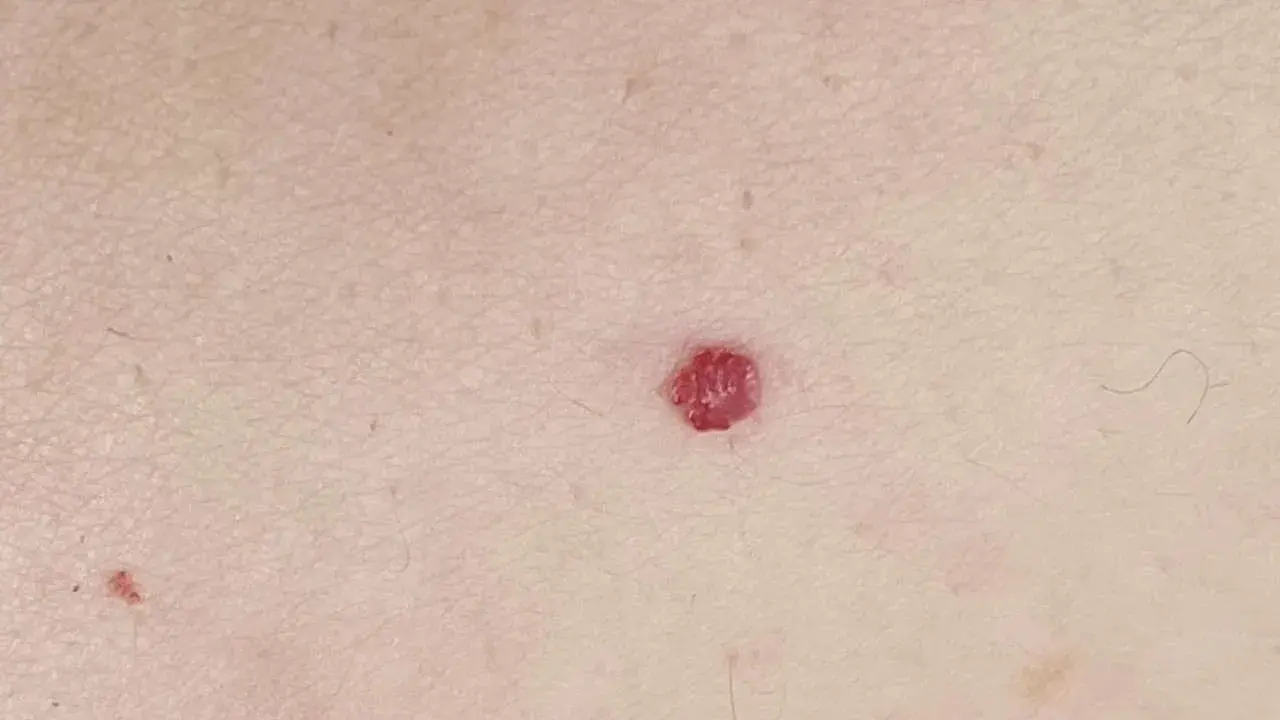 Una piccola macchia rossa sulla pelle, di forma quasi circolare, spicca sulla cute chiara.