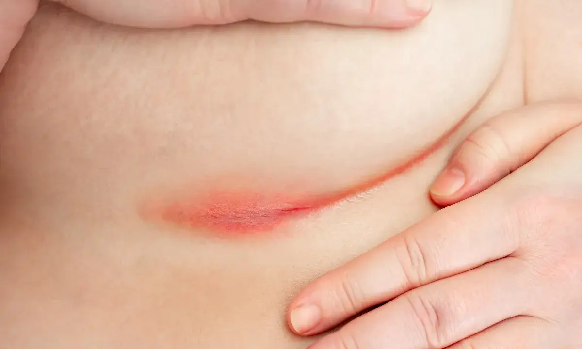 Arrossamento e irritazione cutanea sotto il seno, sintomo di dermatite da sudore. Mani che accarezzano delicatamente la zona interessata.