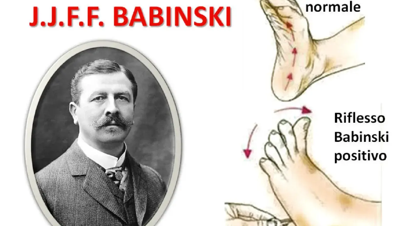 Ritratto di J.J.F. Babinski, con illustrazioni del riflesso normale e del riflesso di Babinski positivo.