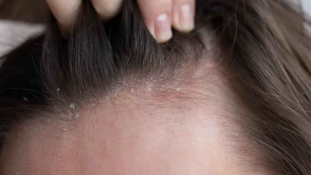 Dettaglio del cuoio capelluto con squame biancastre e arrossamento, indicativo di dermatite atopica.