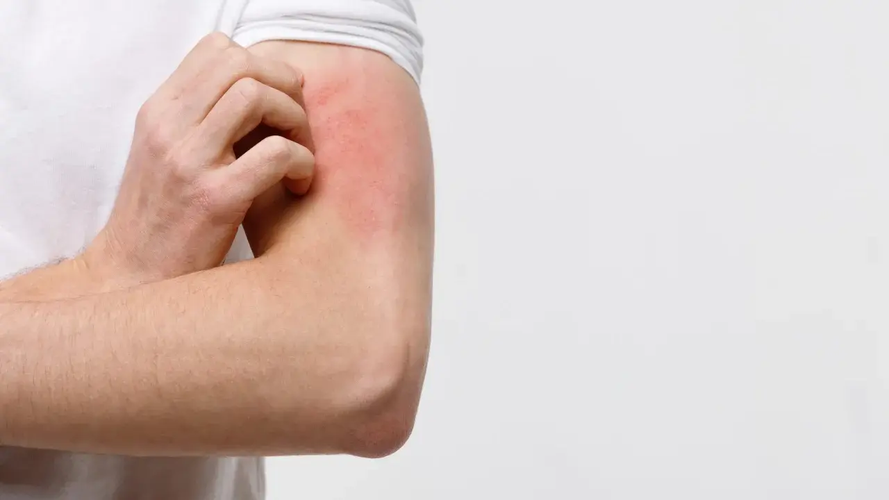 Braccio con arrossamento e prurito, possibile eczema diabetico.