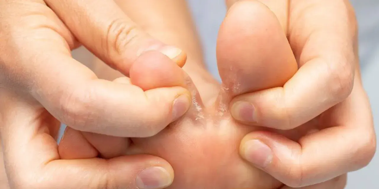 Dita dei piedi con pelle secca e screpolata tra le dita. Un podologo cosa fa? Aiuta a trattare queste condizioni.